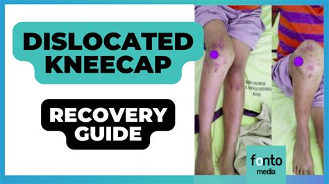 bronze kneecap|dislocated knee healing time.